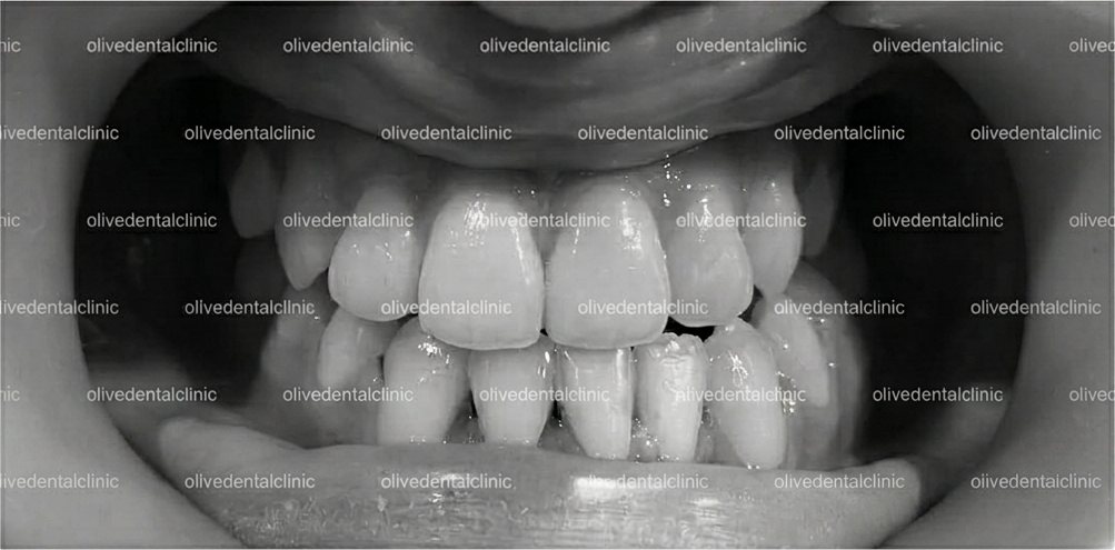 After — orthodontic treatment at Olive Dental, case 3