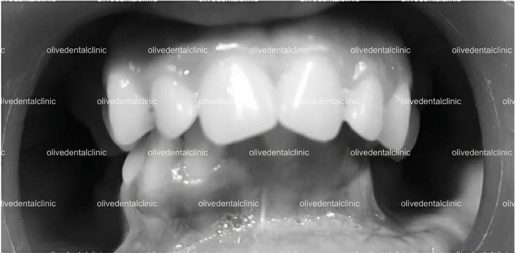 Before — orthodontic treatment at Olive Dental, case 2