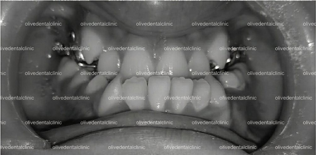 Before — orthodontic treatment at Olive Dental, case 3