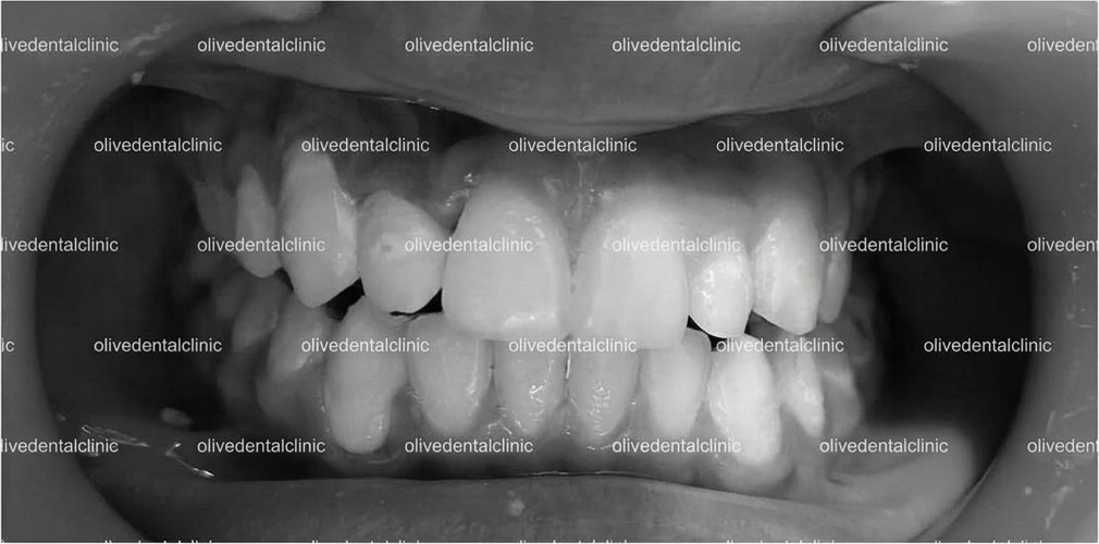 After — orthodontic treatment at Olive Dental, case 1