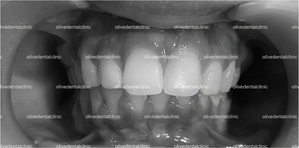 After — orthodontic treatment at Olive Dental, case 2