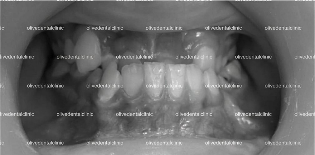 Before — orthodontic treatment at Olive Dental, case 1