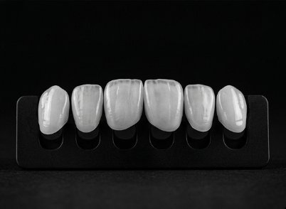 Ultra-thin porcelain veneers